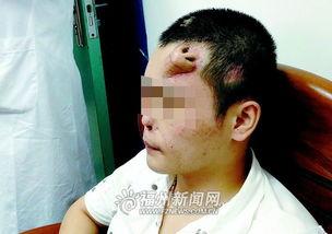 帅哥额头受伤照片